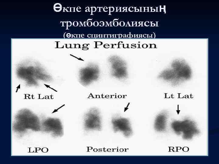 Өкпе артериясының тромбоэмболиясы (өкпе сцинтиграфиясы) 