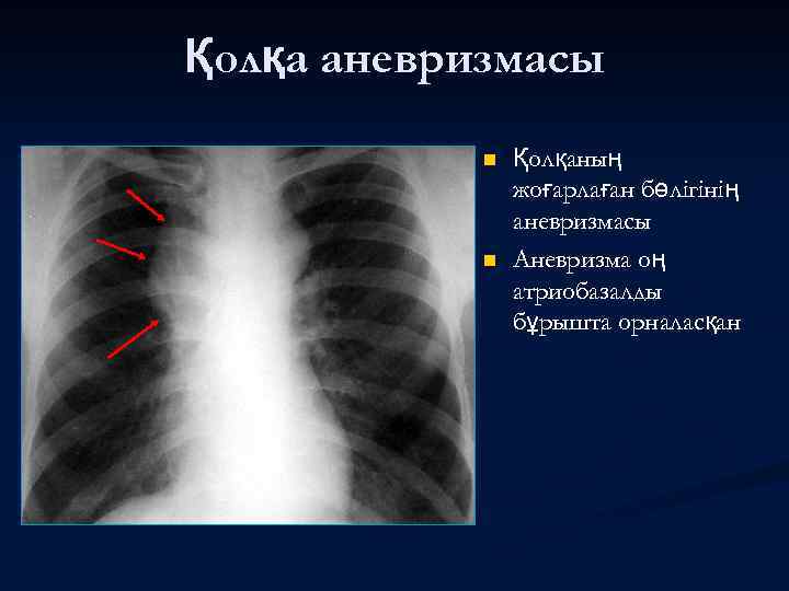 Қолқа аневризмасы n n Қолқаның жоғарлаған бөлігінің аневризмасы Аневризма оң атриобазалды бұрышта орналасқан 