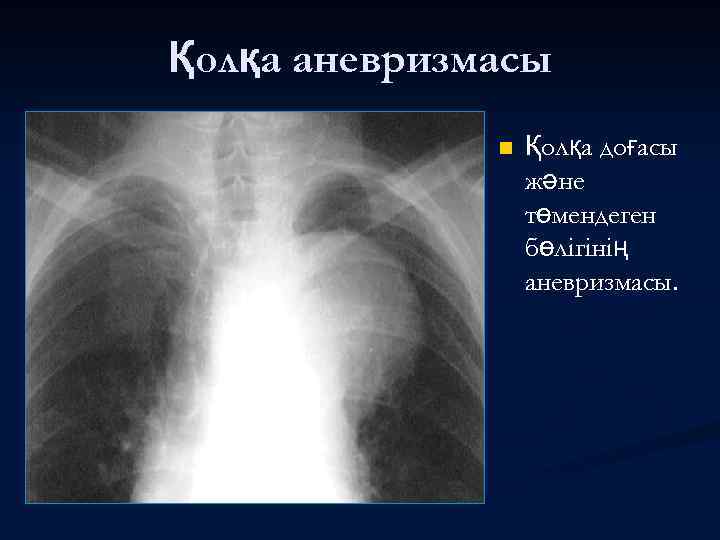 Қолқа аневризмасы n Қолқа доғасы және төмендеген бөлігінің аневризмасы. 