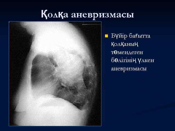 Қолқа аневризмасы n Бүйір бағытта қолқаның төмендеген бөлігінің үлкен аневризмасы 