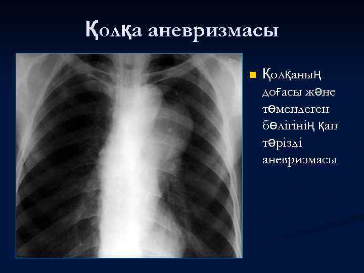 Қолқа аневризмасы n Қолқаның доғасы және төмендеген бөлігінің қап тәрізді аневризмасы 