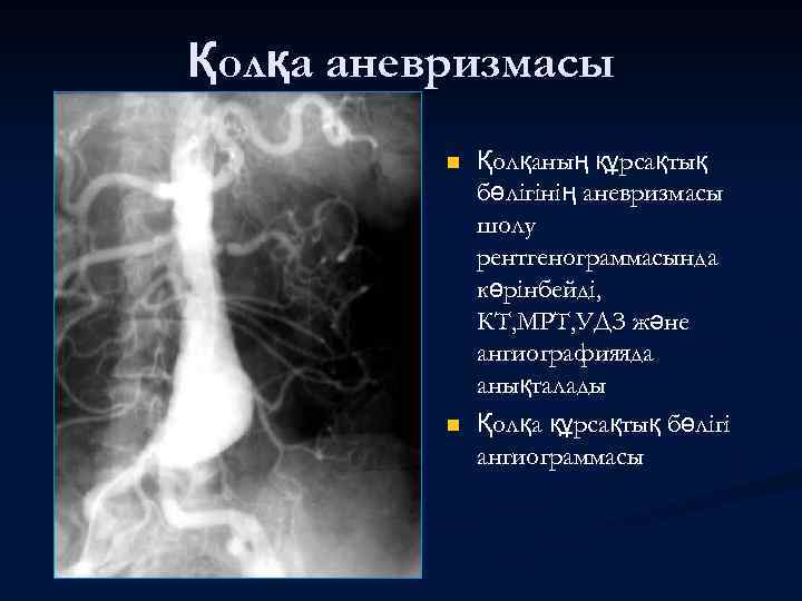 Қолқа аневризмасы n n Қолқаның құрсақтық бөлігінің аневризмасы шолу рентгенограммасында көрінбейді, КТ, МРТ, УДЗ