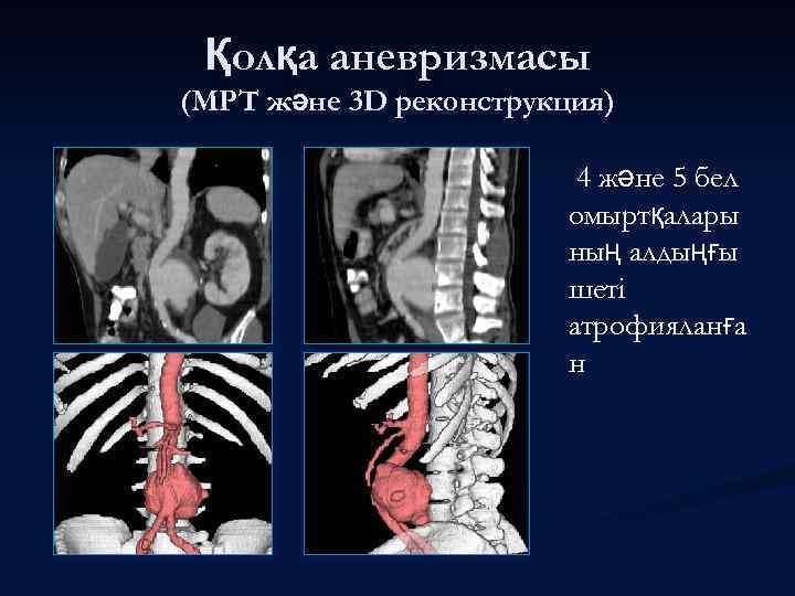 Қолқа аневризмасы (МРТ және 3 D реконструкция) 4 және 5 бел омыртқалары ның алдыңғы