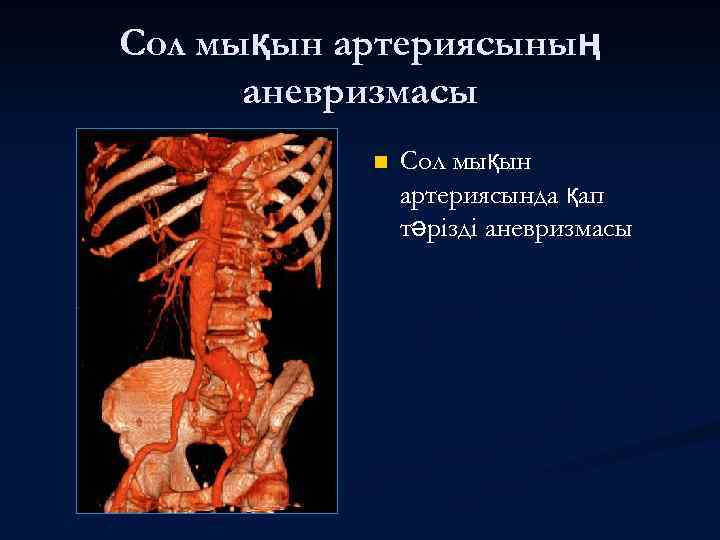 Сол мықын артериясының аневризмасы n Сол мықын артериясында қап тәрізді аневризмасы 