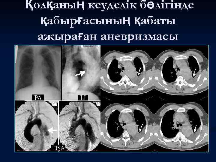 Қолқаның кеуделік бөлігінде қабырғасының қабаты ажыраған аневризмасы 