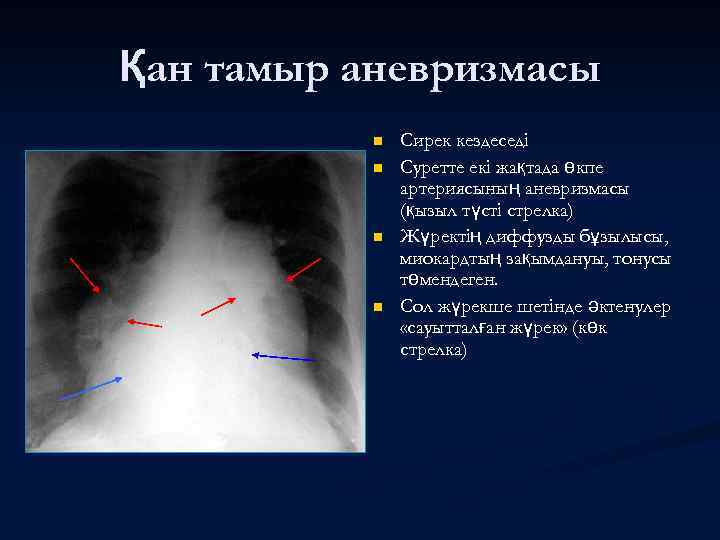 Қан тамыр аневризмасы n n Сирек кездеседі Суретте екі жақтада өкпе артериясының аневризмасы (қызыл