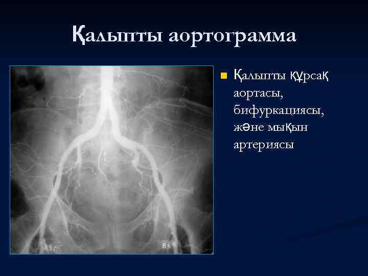 Қалыпты аортограмма n Қалыпты құрсақ аортасы, бифуркациясы, және мықын артериясы 