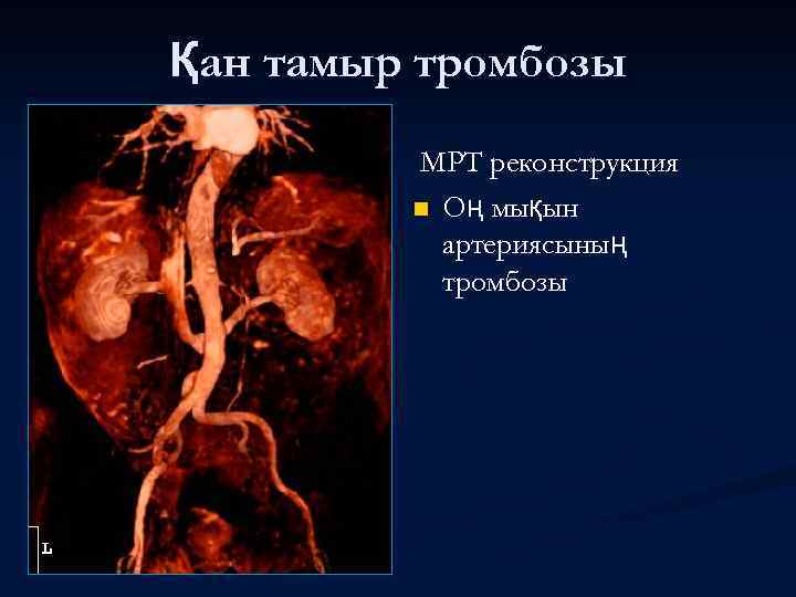 Қан тамыр тромбозы МРТ реконструкция n Оң мықын артериясының тромбозы 