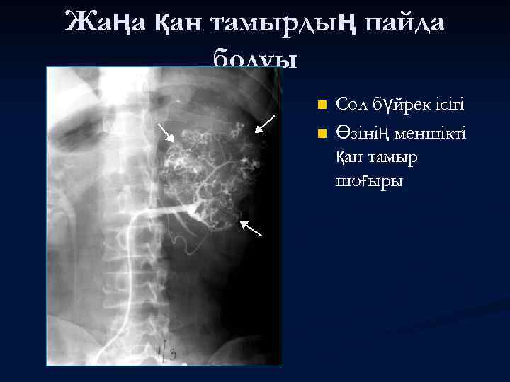 Жаңа қан тамырдың пайда болуы n n Сол бүйрек ісігі Өзінің меншікті қан тамыр