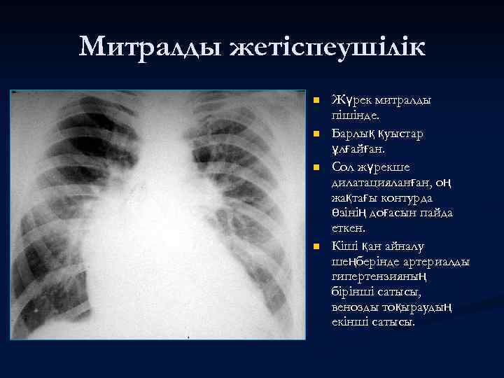 Митралды жетіспеушілік n n Жүрек митралды пішінде. Барлық қуыстар ұлғайған. Сол жүрекше дилатацияланған, оң