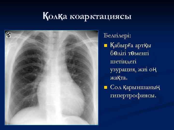 Қолқа коарктациясы Белгілері: n Қабырға артқы бөлігі төменгі шетіндегі узурация, жиі оң жақта. n