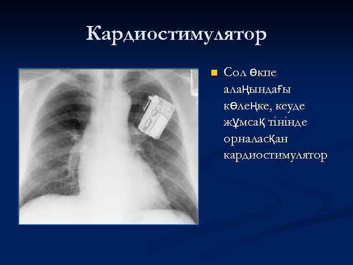 Кардиостимулятор n Сол өкпе алаңындағы көлеңке, кеуде жұмсақ тінінде орналасқан кардиостимулятор 
