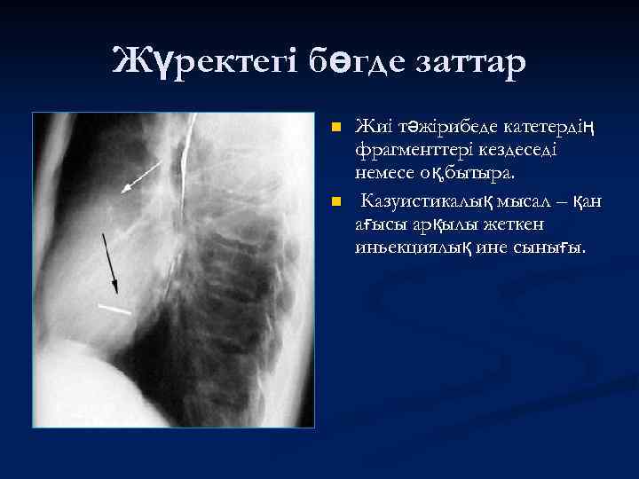 Жүректегі бөгде заттар n n Жиі тәжірибеде катетердің фрагменттері кездеседі немесе оқ, бытыра. Казуистикалық