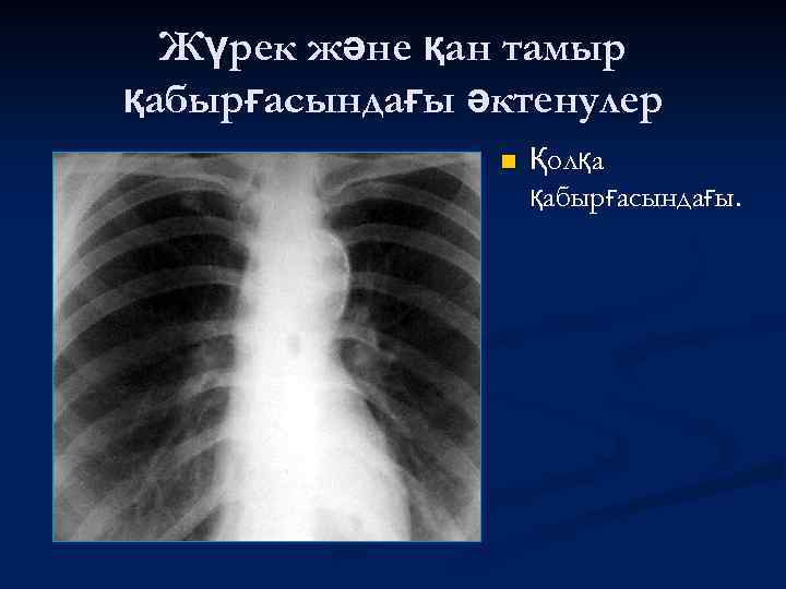Жүрек және қан тамыр қабырғасындағы әктенулер n Қолқа қабырғасындағы. 