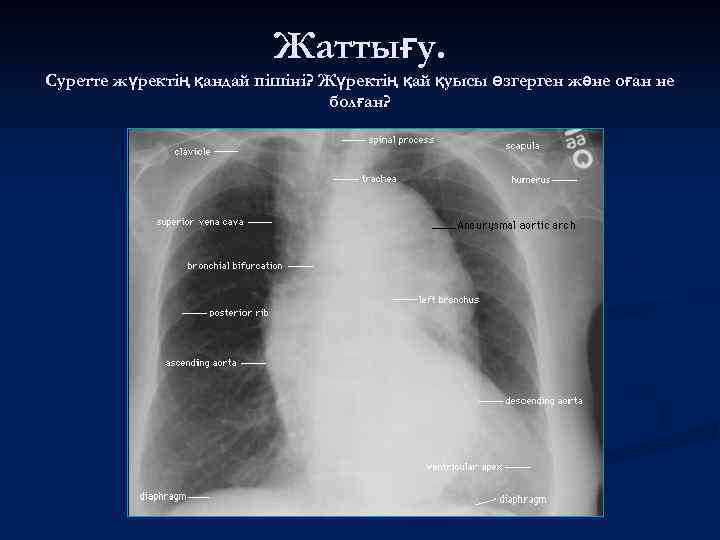 Жаттығу. Суретте жүректің қандай пішіні? Жүректің қай қуысы өзгерген және оған не болған? 