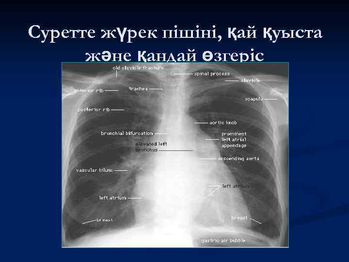 Суретте жүрек пішіні, қай қуыста және қандай өзгеріс 