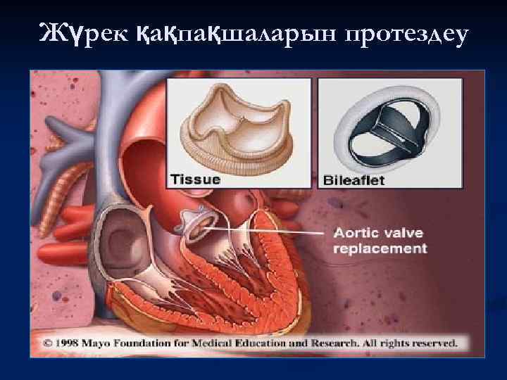 Жүрек қақпақшаларын протездеу 