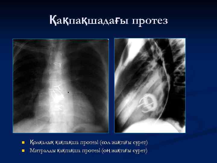 Қақпақшадағы протез n n Қолқалық қақпақша протезі (сол жақтағы сурет) Митралды қақпақша протезі (оң