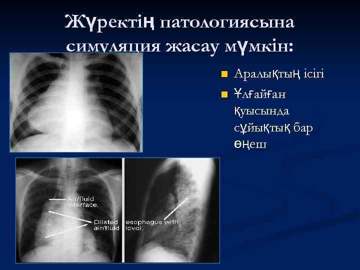 Жүректің патологиясына симуляция жасау мүмкін: n n Аралықтың ісігі Ұлғайған қуысында сұйықтық бар өңеш