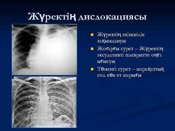 Жүректің дислокациясы n n n Жүректің екіншілік зақымдануы Жоғарғы сурет – Жүректің эксудативті плевритте