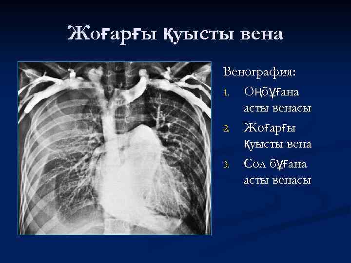 Жоғарғы қуысты вена Венография: 1. Оңбұғана асты венасы 2. Жоғарғы қуысты вена 3. Сол