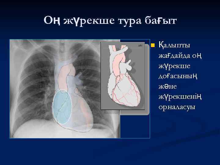 Оң жүрекше тура бағыт n Қалыпты жағдайда оң жүрекше доғасының және жүрекшенің орналасуы 