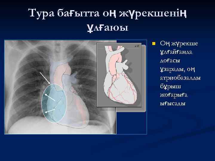 Тура бағытта оң жүрекшенің ұлғаюы n Оң жүрекше ұлғайғанда доғасы ұзарады, оң атриобазалды бұрыш
