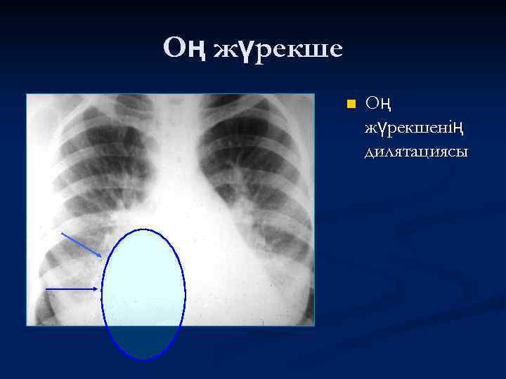 Оң жүрекше n Оң жүрекшенің дилятациясы 