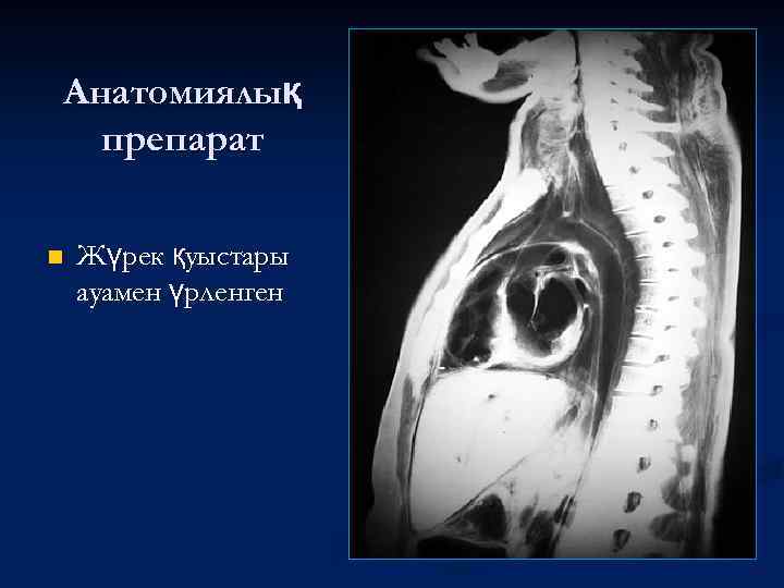 Анатомиялық препарат n Жүрек қуыстары ауамен үрленген 