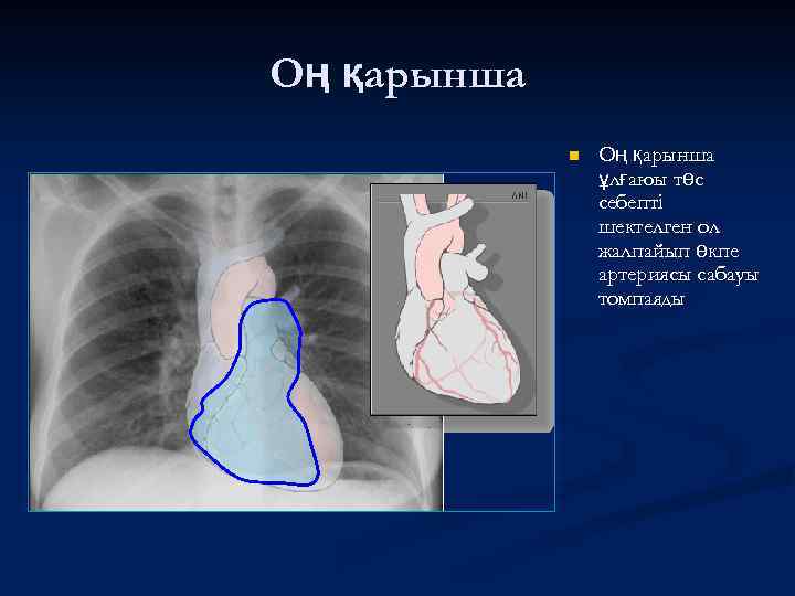 Оң қарынша n Оң қарынша ұлғаюы төс себепті шектелген ол жалпайып өкпе артериясы сабауы