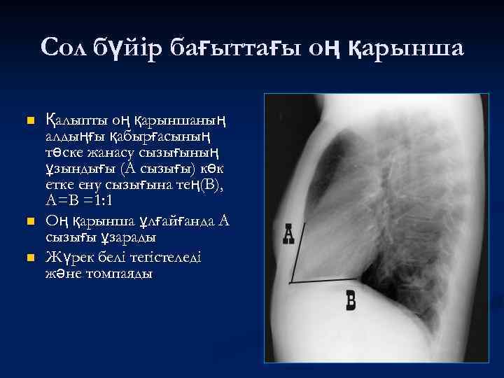 Cол бүйір бағыттағы оң қарынша n n n Қалыпты оң қарыншаның алдыңғы қабырғасының төске