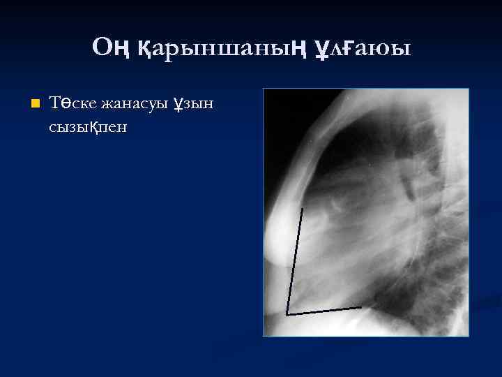 Оң қарыншаның ұлғаюы n Төске жанасуы ұзын сызықпен 