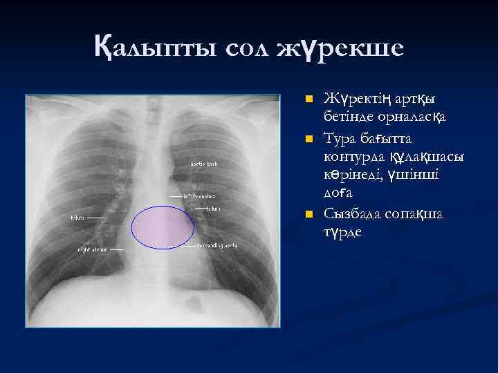 Қалыпты сол жүрекше n n n Жүректің артқы бетінде орналасқа Тура бағытта контурда құлақшасы