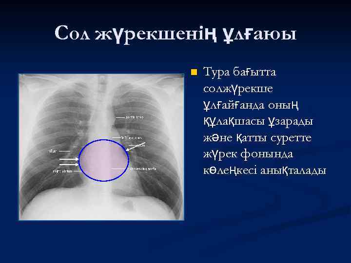 Сол жүрекшенің ұлғаюы n Тура бағытта солжүрекше ұлғайғанда оның құлақшасы ұзарады және қатты суретте