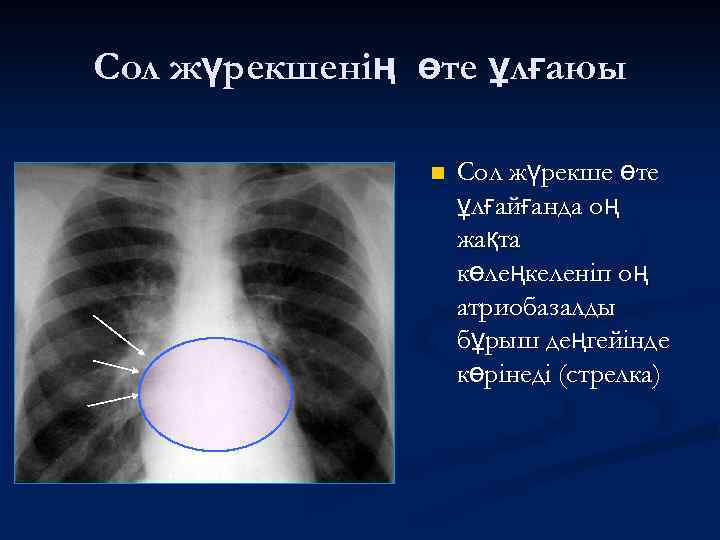 Сол жүрекшенің өте ұлғаюы n Сол жүрекше өте ұлғайғанда оң жақта көлеңкеленіп оң атриобазалды