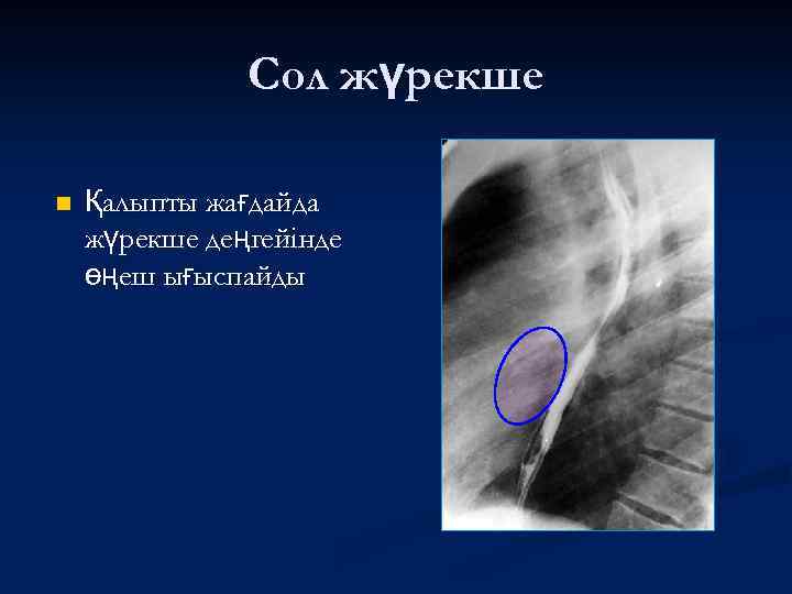 Сол жүрекше n Қалыпты жағдайда жүрекше деңгейінде өңеш ығыспайды 