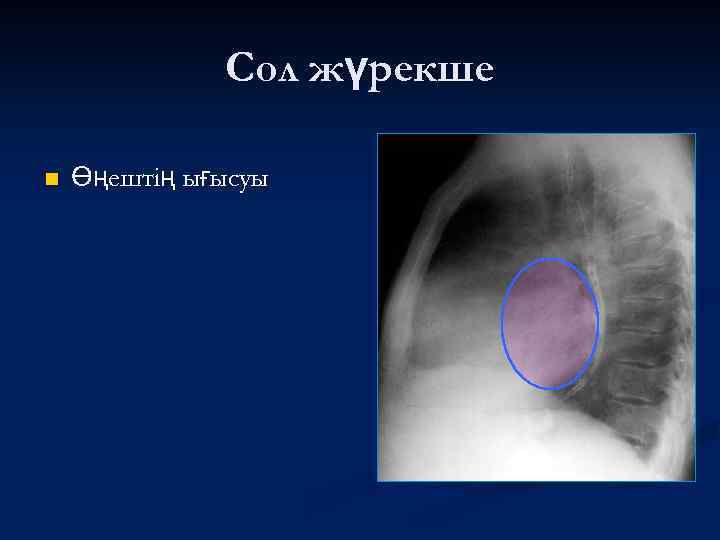 Сол жүрекше n Өңештің ығысуы 