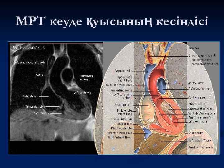 МРТ кеуде қуысының кесіндісі 