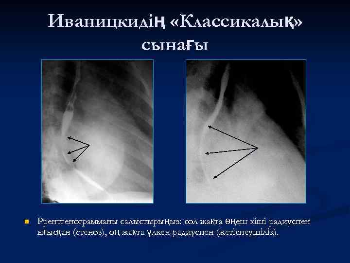Иваницкидің «Классикалық» сынағы n Ррентгенограмманы салыстырыңыз: сол жақта өңеш кіші радиуспен ығысқан (стеноз), оң