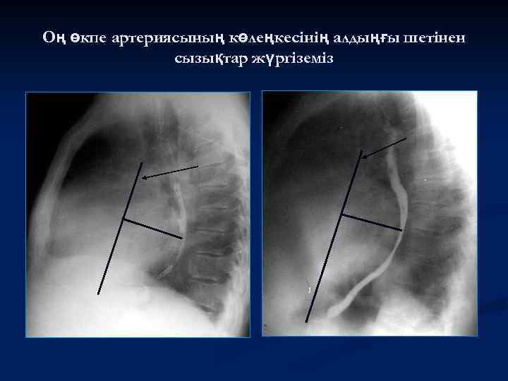 Оң өкпе артериясының көлеңкесінің алдыңғы шетінен сызықтар жүргіземіз 