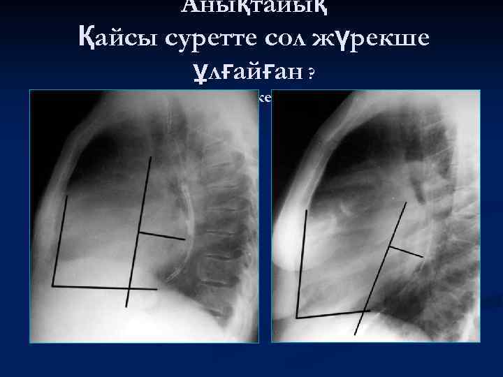 Анықтайық Қайсы суретте сол жүрекше ұлғайған ? А правый желудочек? 