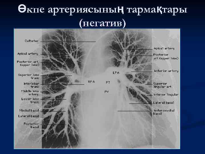 Өкпе артериясының тармақтары (негатив) 