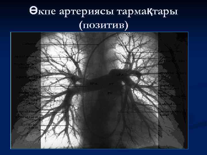 Өкпе артериясы тармақтары (позитив) 