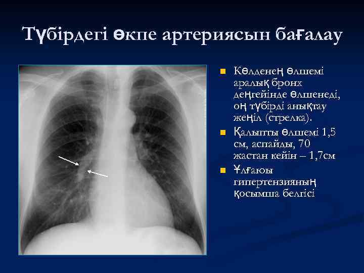 Түбірдегі өкпе артериясын бағалау n n n Көлденең өлшемі аралық бронх деңгейінде өлшенеді, оң