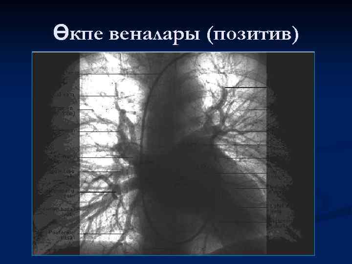 Өкпе веналары (позитив) 