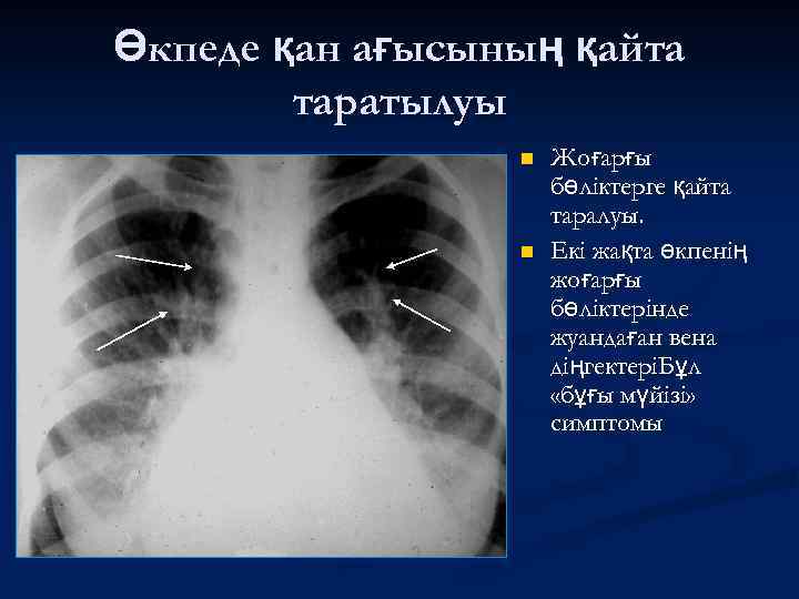 Өкпеде қан ағысының қайта таратылуы n n Жоғарғы бөліктерге қайта таралуы. Екі жақта өкпенің