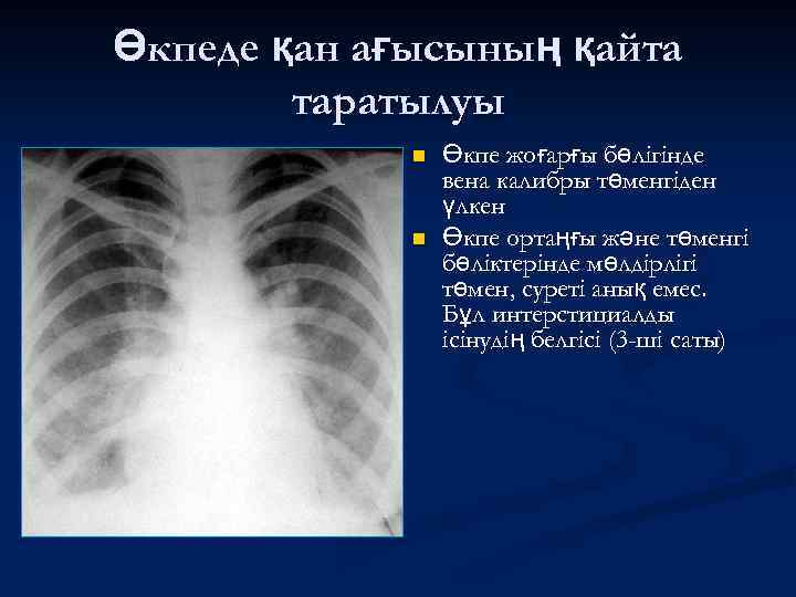 Өкпеде қан ағысының қайта таратылуы n n Өкпе жоғарғы бөлігінде вена калибры төменгіден үлкен
