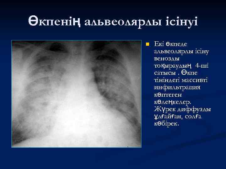 Өкпенің альвеолярлы ісінуі n Екі өкпеде альвеолярлы ісіну венозды тоқыраудың 4 -ші сатысы. Өкпе