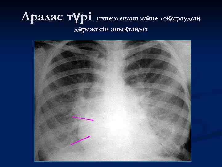 Аралас түрі гипертензия және тоқыраудың дәрежесін анықтаңыз 