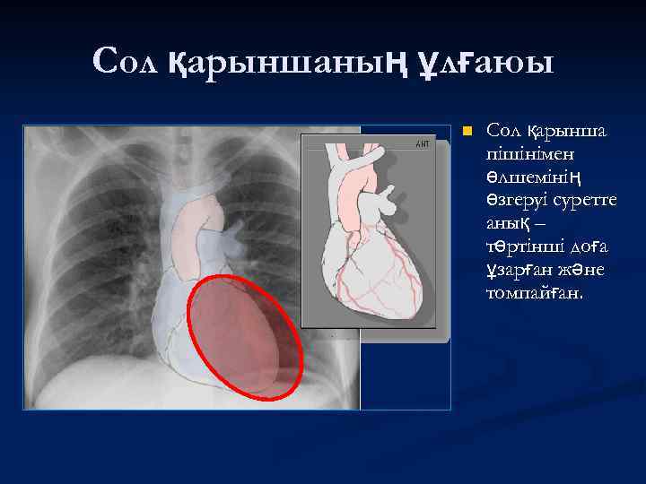 Сол қарыншаның ұлғаюы n Сол қарынша пішінімен өлшемінің өзгеруі суретте анық – төртінші доға